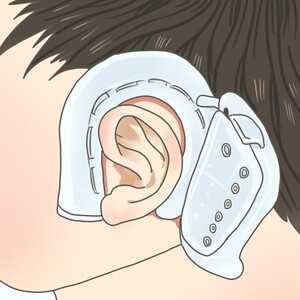 婴儿耳垂矫正器