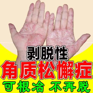 剥脱性角质松懈症癣菌瘆手鳞屑手指心汗泡疹保健膏脱褪皮止痒杀菌