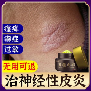 治疗神经性皮炎去根除外用膏顽固无激素日光性过敏止痒皮肤病癣藓