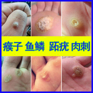 瘊子药祛刺猴去除正品手足部去猴子肉粒疙瘩脚肉刺鱼鳞痣贴去除膏