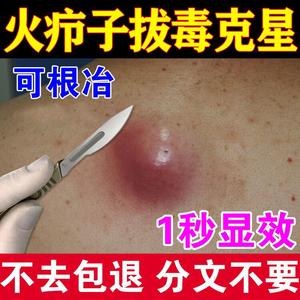 火疖子拔脓膏拔毒膏吸脓头筋络通皮脂腺痘痘神器同仁堂