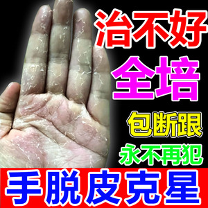 剥脱性角质松懈症治疗严重手脱皮儿童手指手心干燥干裂的专用药膏