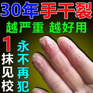 治手裂的药膏防手裂蜕皮开裂干脱皮止痒手气季节性反复型一抹就好