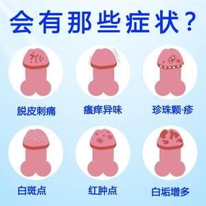 龟头炎症溃烂皮裂白垢红肿脱皮殖冠状沟瘙痒霉uli开毒男包性生清