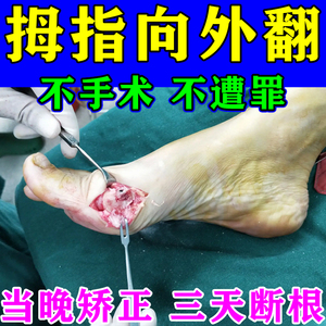 拇指外翻克星矫正器女士脚趾重叠疼痛防磨大脚骨外翻畸形专用药贴