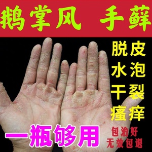 可根治鹅掌风小偏方图片