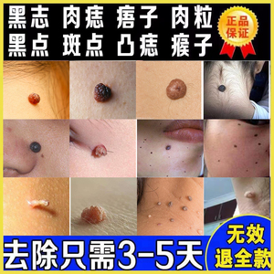 去肉痣