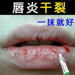 慢性唇炎润唇膏嘴唇干裂结痂嘴角烂过敏脱皮红肿瘙痒保湿修复膏