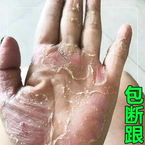 手脱皮严重脱皮专用真菌蜕皮干燥起皮治疗儿童手指开裂用什么药膏