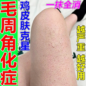 毛周角化症鸡皮肤疙瘩毛囊角化药膏手臂脸部腿上起皮角质去除神器