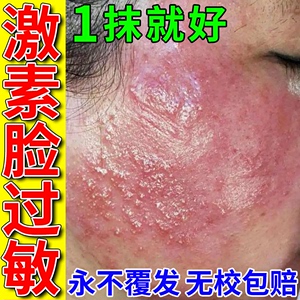 脸上过敏皮肤痒药膏专用修复激素脸部干燥起皮红痒脂溢性皮炎止痒