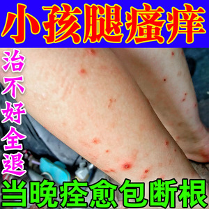 治腿痒的药夏天热儿童小孩小腿皮肤干燥换季宝宝身上起红疙瘩止痒