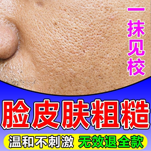 男士脸部皮肤粗糙修复干燥起皮有碎屑收缩毛孔去黑头粉刺毛孔粗大