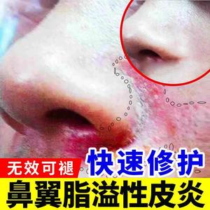 脂溢性皮炎鼻翼溢脂性鼻子两侧发红脱皮干燥起皮脸部两边泛红霜OS