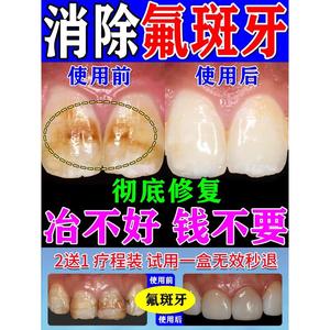 稀盐酸氟斑牙专用牙膏牙齿美白美牙仪药水牙釉质牙菌斑牙渍垢神器