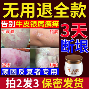 止痒药膏皮肤抑菌止痒外用