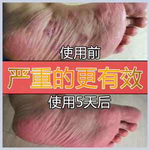 脚气神油包邮正品