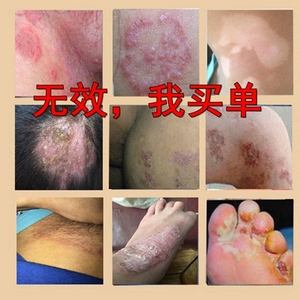 百毒王癣痒灵阴囊湿毒抑菌成人股藓体头牛皮廯乳膏皮肤痒止痒软膏