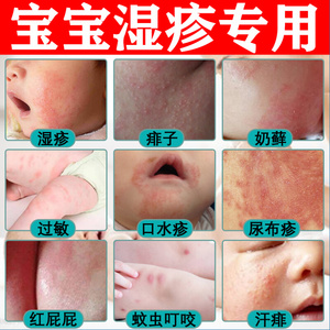吴高勇诚信淘宝婴儿童宝宝湿疹膏皮炎皮肤过敏瘙痒止痒去根尿布疹无