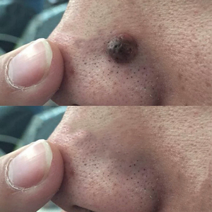 caiye606淘宝去黑痣无痕去脸上黑点神器点美容院家用苍蝇屎黑痔脸部