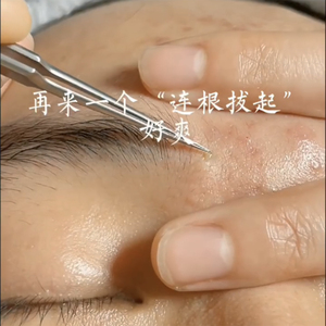 骆王宇超细5号细胞夹去黑头镊子美容院专用粉刺针挤痘痘工具医用