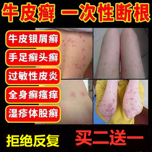 灰黄霉素人用灰黄霉素软膏甲癣抗真菌灰黄霉素头癣治头癣药膏外用
