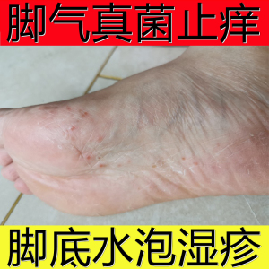 治疗脚气的药膏