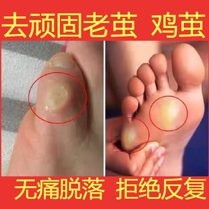 祛老茧脚茧手上去除脚底厚茧脚垫膏关节茧脚趾死皮软化剂鸡眼神器