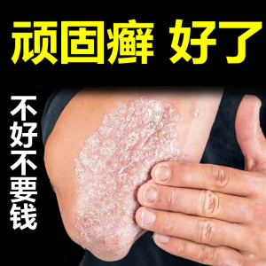 李氏百草膏皮肤癣药膏牛皮癣银屑癣外用鲜藓治疗手足藓体股藓止痒