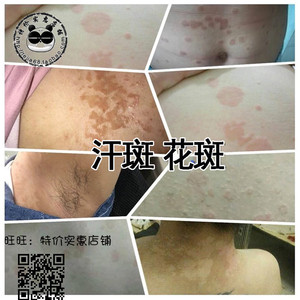 去汗斑膏特效