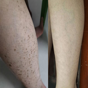 鸡皮肤去除蛇皮鱼鳞皮肤腿部病克星干燥起脱皮神器全身身体乳霜