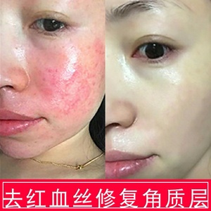 祛红血丝护肤品脸部
