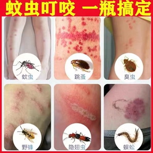 治疗蚂蚁咬伤药膏臭虫虱子毒治跳蚤咬的隐翅虫子蚊虫叮咬止痒药膏