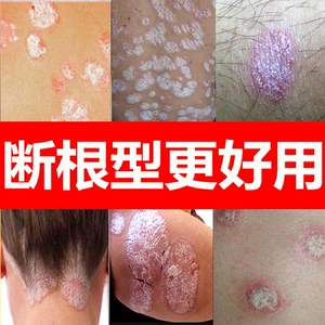 湿疹止痒牛神经性皮炎去根除平癣藓药膏外用皮肤真菌感染手足瘙痒
