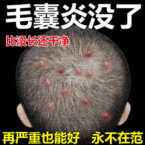 毛囊炎膏治疗头皮头部脸部胸后背手臂腿头上长痘痘疙瘩特效专用药