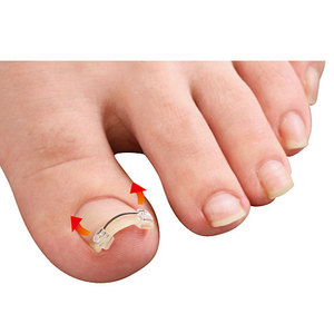 日本进口脚趾甲弯曲内嵌甲矫正器甲沟指甲长肉里卷甲拉拉贴正甲贴