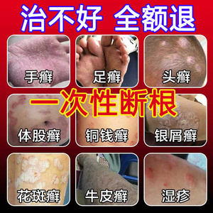 00美好印象医疗器械专营店天猫黄麻子喷剂皮肤瘙痒止痒抑菌藓药膏