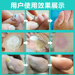 鸡眼贴修正去脚手部足部脚底刀疣脚趾正品同仁堂鸡眼药膏帖鸡尤液