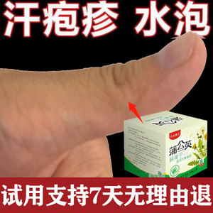 去根汗泡疱疹汉状汗状疱疹小水泡手指脚脱皮止痒儿童药膏肤