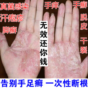 手癣膏鹅掌风真菌感染蜕皮开裂手痒水泡脱皮手藓鲜膏治疗专用药膏