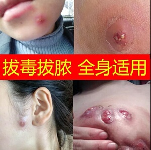 金鸡拔毒膏祛痘湿疹火疖子皮脂腺不复发清湿贴治屁股旗舰吸外用