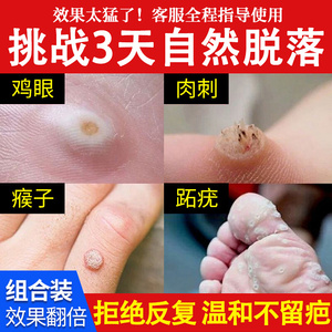 鸡眼膏鸡眼贴鸡尤灵猴子去除手足部脚底脚趾老茧肉刺鸡眼药鸡疣灵