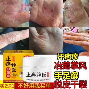 汗疱疹手癣脱皮药膏真菌感染汗状孢疹手上小水泡苗家手气专用软膏