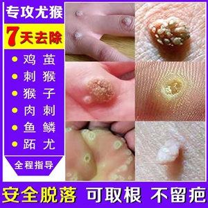 药膏去除刺猴肉疣疙瘩正品药贴祛手足部瘊子肉刺鸡眼神器康乐安居