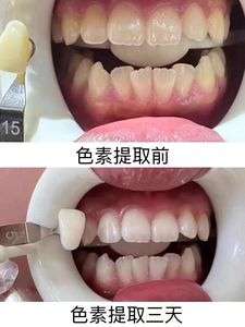 1分钟美牙原牙色素提取美白凝胶过氧化氢牙齿护理源头工厂