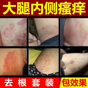 大腿内侧瘙痒湿疹止痒去根癣药膏藓正品杀菌皮肤瘙痒抑菌私处外用