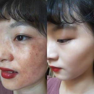 祛斑霜淡斑去斑点脸部美白神器黄褐斑淡化色斑吸斑强力女雀斑去.