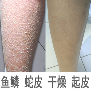 蛇皮肤霜去鱼鳞腿纹路全身干燥脱皮病保湿滋润补水身体乳干性肤质