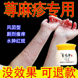 荨麻疹膏风团