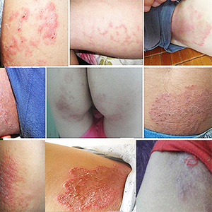 百代医传乳膏皮肤瘙痒止痒成人外用药男大腿内侧私处屁股狼毒软膏